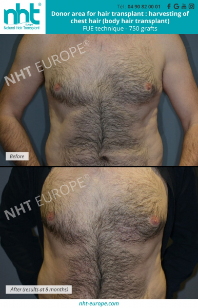 donor-area-for-hair-transplant-harvesting-of-chest-hair-body-hair-transplant-fue-technique-750-grafts