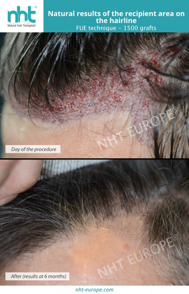 results-of-the-recipient-area-on-the-hairline-fue-technique-hair-transplant