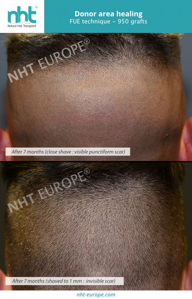 hairtransplant-donor-area-healing-fue-technique-950-grafts
