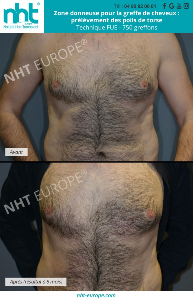 cicatrisation zone donneuse greffe de cheveux prelevement des poils du torse body hair transplant greffe de cheveux avant apres