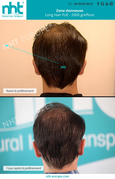 zone-donneuse-greffe-de-cheveux-implant-capillaire-prelevement-cheveux-longs-long-haur-fue-invisible-des-le-lendemain-de-l'intervention-2000-greffons-clinique-centre-nht-avignon-france