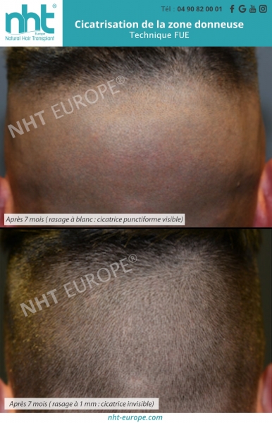 cicatrisation de la zone donneuse 7 mois post operatoire greffe de cheveux cicatrice invisible