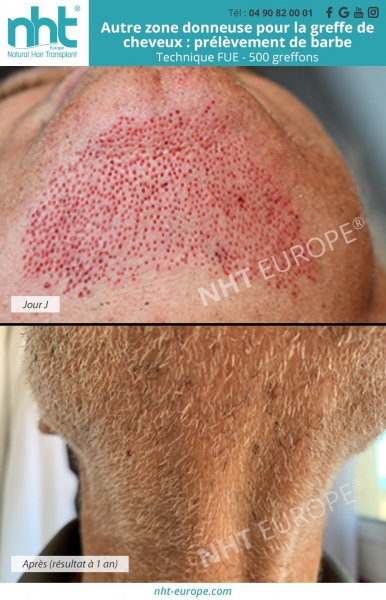 zone donneuse pour la greffe de cheveux prelevement de 500 greffons sur la barbe