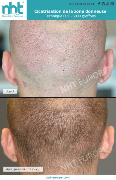 cicatrisation cuir chevelu repousse des cheveux apres une greffe capillaire