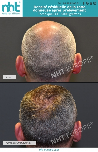 densité de la zone donneuse apres prelevement greffe de cheveux technique fue