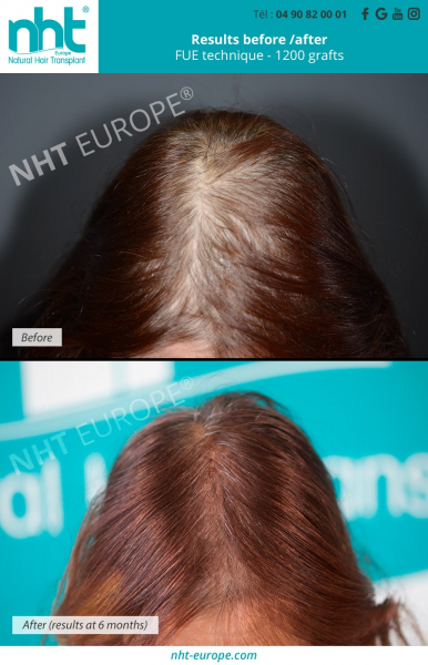 Hair-transplant-on-woman-women-alopecia-arreata-hair-loss-baldness-bald-spot-scalp-solution-treatment