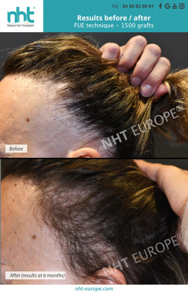 woman-hair-transplantation-results-before-after-1500-grafts-hair-growth