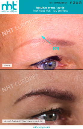 greffe de sourcils resultats avant apres effet browlift epaissir faire pousser ses sourcils microshading microblading