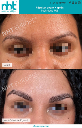 greffe-de-sourcils-resultats-avant-apres-effet-browlift-epaissir-faire-pousser-ses-sourcils-microshading-microblading-maquillage-semi-permanent