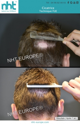 greffe de cheveux fue sur une cicatrice cuir chevelu resultat avant apres