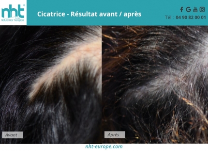 greffe de cheveux sur une cicatrice femme