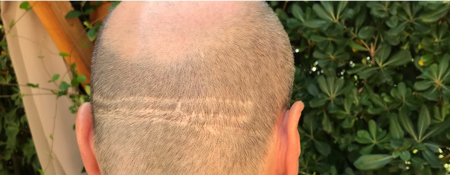 Conceal a Scar with a Hair Transplant in Avignon France