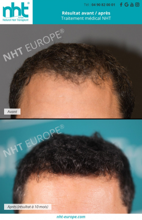 traitement-medical-contre-la-chute-des-cheveux-resultats-avant-apres-sur-la-ligne-frontale-densite-solution-contre-la-calvitie-alopecie-pelade