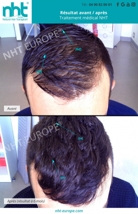 repousse-des-cheveux-traitement-medical-contre-la-chute-des-cheveux-calvitie-homme-prp-capillaire-resultat-avant-apres