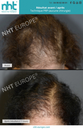 traitement-capillaire-femme-contre-la-chute-de-cheveux-injection-de-prp-repousse