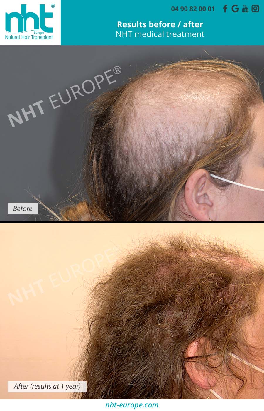 Nano Fat Graft (Nanofat) in Avignon, France - Hair Loss