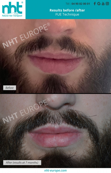 beard and mustache transplant at 7 months