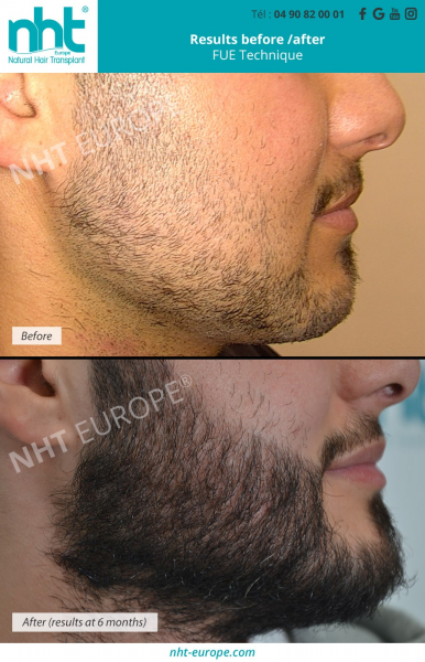 beard transplant for more density before after results