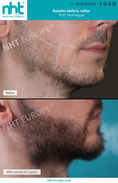 beard transplant growth results before after