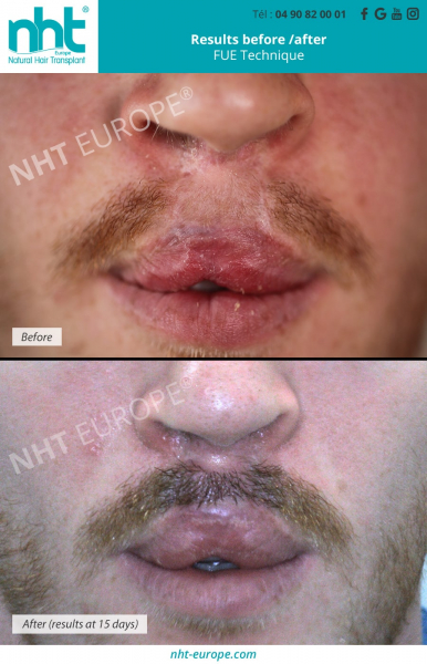 beard transplant on scar mustache harelip