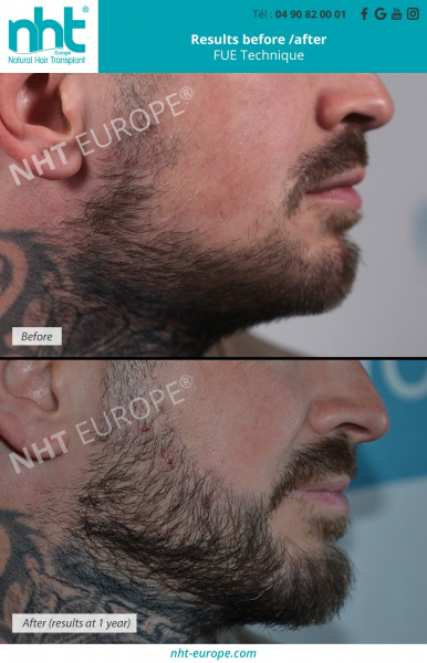 before after beard transplant growth