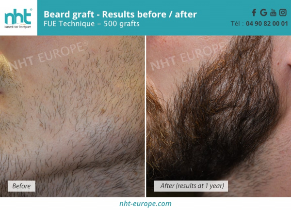 before-after-beard-transplantation-results-at-1-year-500-grafts