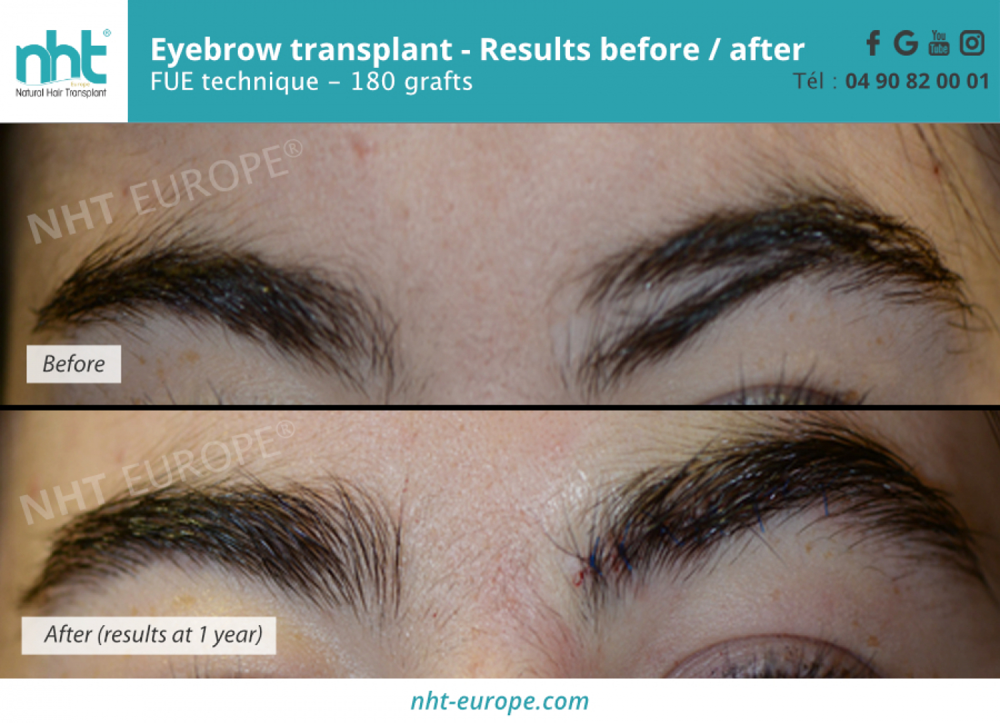 Before/After Photos Results Eyebrow Transplant in Avignon