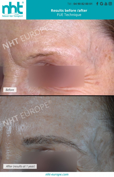 eyebrow transplant woman before after results 1 year