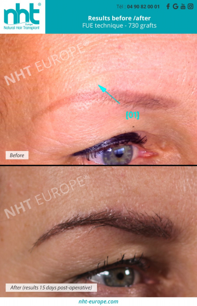 eyebrow-transplant-result-before-after-15-days-microblading-grow-eyebrow