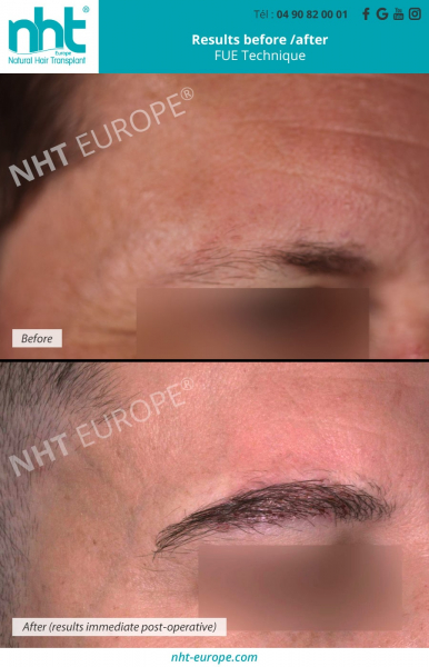 eyebrow transplantation man before after results
