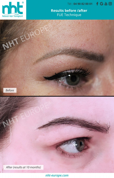 eyebrow-transplant-result-before-after-10-month-microblading-grow-eyebrow-fue-technique
