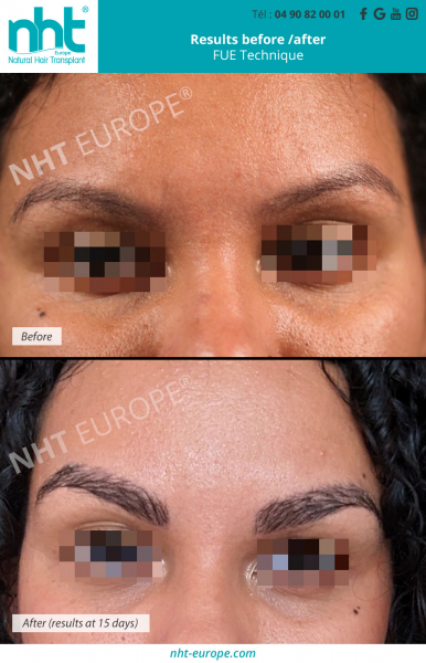 eyebrow-transplant-browlift-microblading-eyebrow-regrowth-microshading-clinic-france-