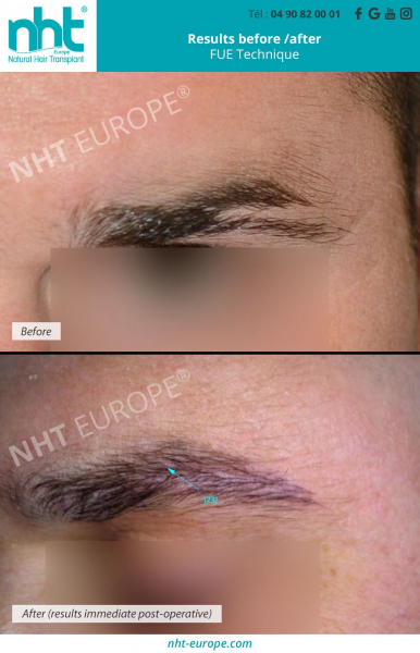 eyebrow transplantation men before after results fue technique