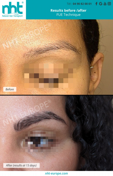 eyebrow-transplant-browlift-microblading-eyebrow-regrowth-microshading-clinic-france-