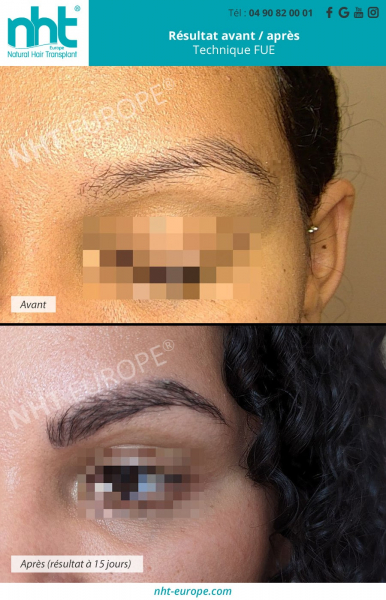 implant-greffe-de-sourcils-femme-resultat-avant-apres-maquillage-tatouage-semi-permanent-microblading-microshading-brow-lift-teinture-sourcils-fournis-comment-faire-pousser-les-sourcils-clinique-france-avignon