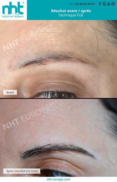 greffe de sourcils naturelle complete resultat avant apres
