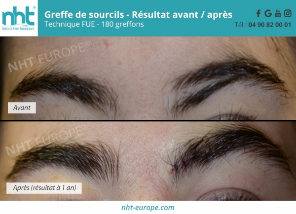 greffe-de-sourcils-resultat-avant-apres-1-an-180-greffons-comblage-des-trous