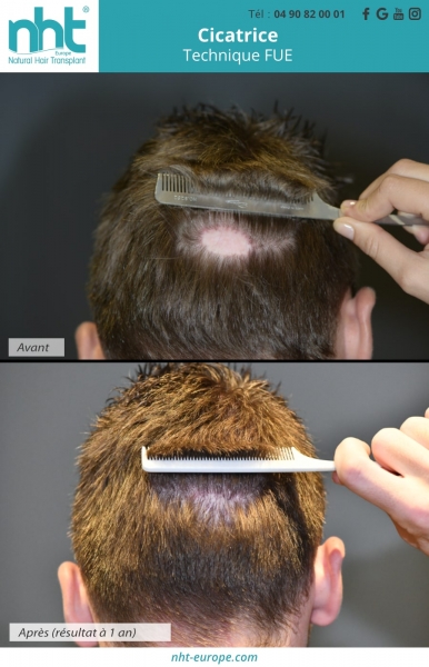 greffe-de-cheveux-sur-une-cicatrice-technique-fue