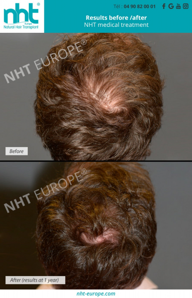 results-before-after-nht-medical-treatment-hair-loss-hair-growth-1-year