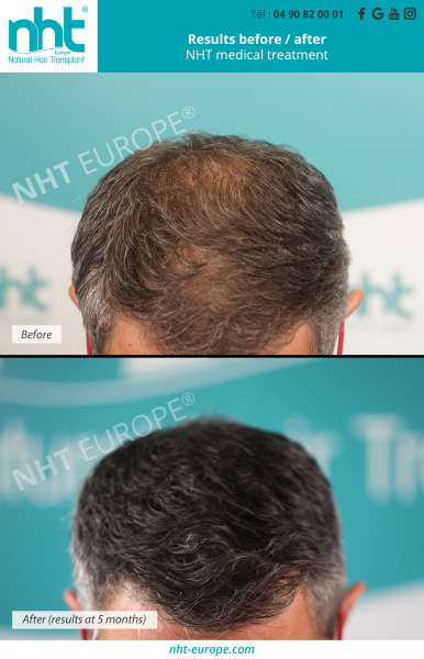 hair-loss-medical-treatment-alopecia-before-after-hairgrowth-density-prp