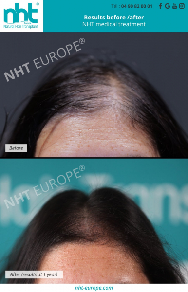 before-after-results-nht-medical-treatment-against-hair-loss-alopecia-baldness-prp-dna-test-hairgrowth-woman-women-france-