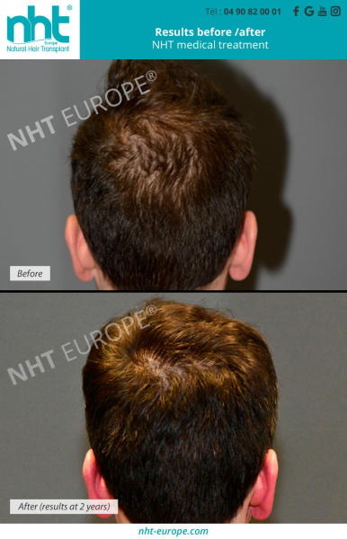 medical-treatment-for-hair-hairloss-hairgrowth-thick-hair-2-years-after-prp