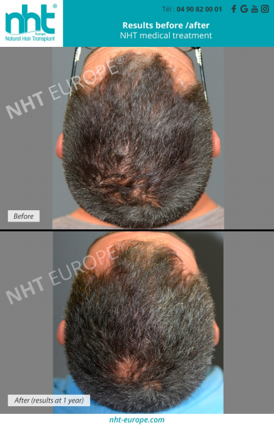 prp-for-hair-medical-treatment-against-baldness-hairloss-before-after-results