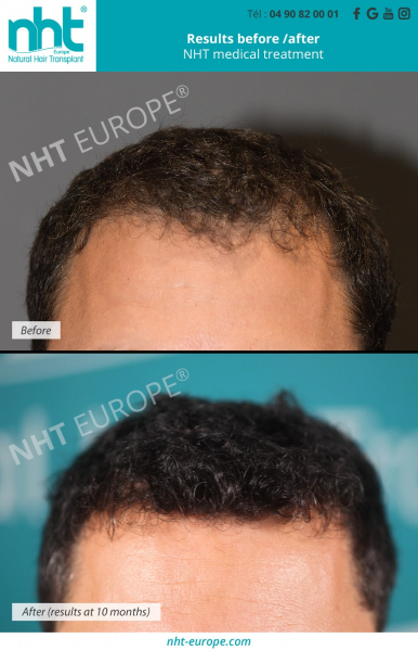 before-after-results-nht-medical-treatment-against-hair-loss-alopecia-baldness-prp-dna-test-hairgrowth-france