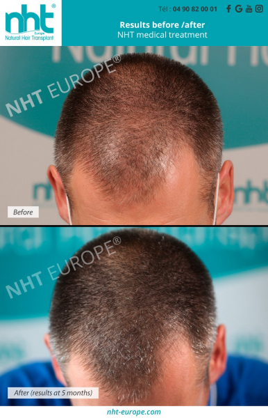 before-after-5-months-of-medical-treatment-against-hairloss-nht-europe-natural-hair-transplant