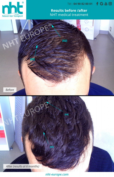 medical-treatment-before-after-11-months-prp-hairloss-solution-man-men-natural-hair-transplant-france