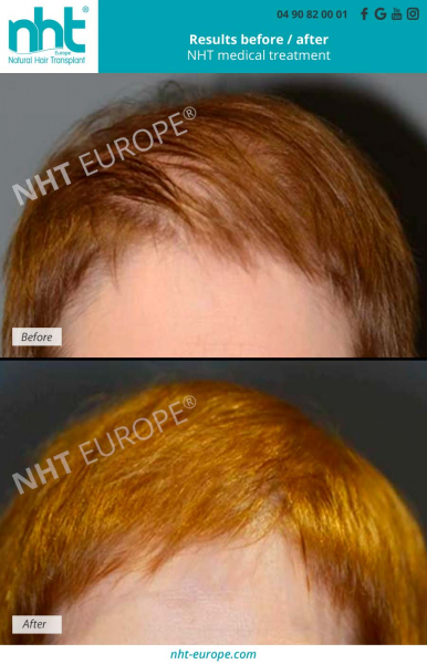 hair-loss-medical-treatment-alopecia-before-after-hairgrowth-density