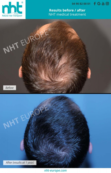 medical-treatment-against-hairloss-before-after-result-man