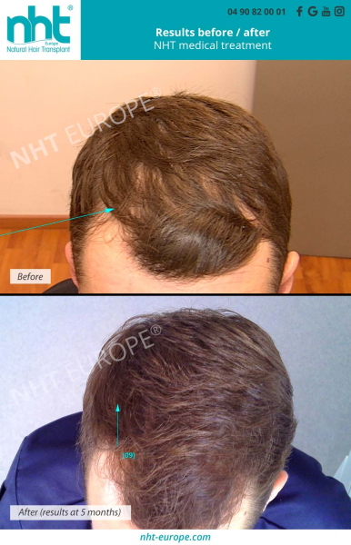 before-after-results-using-medical-treatment-against-hairloss-dna-test-man