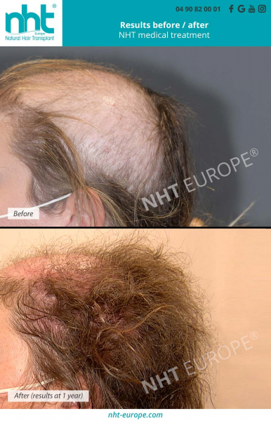 results-before-after-medical-treatment-hairloss-nanofat